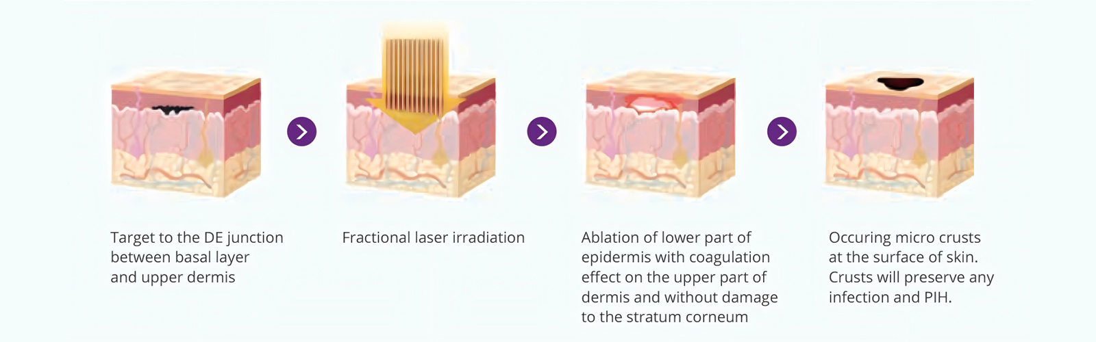 Therapeutic-Mechanism-of-LumiGlam-Pro-1927+1550nm-Fractional-Laser-Machine