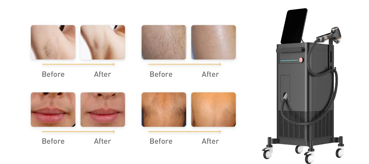 Как выбрать надежного поставщика машины удаления волос лазера диода